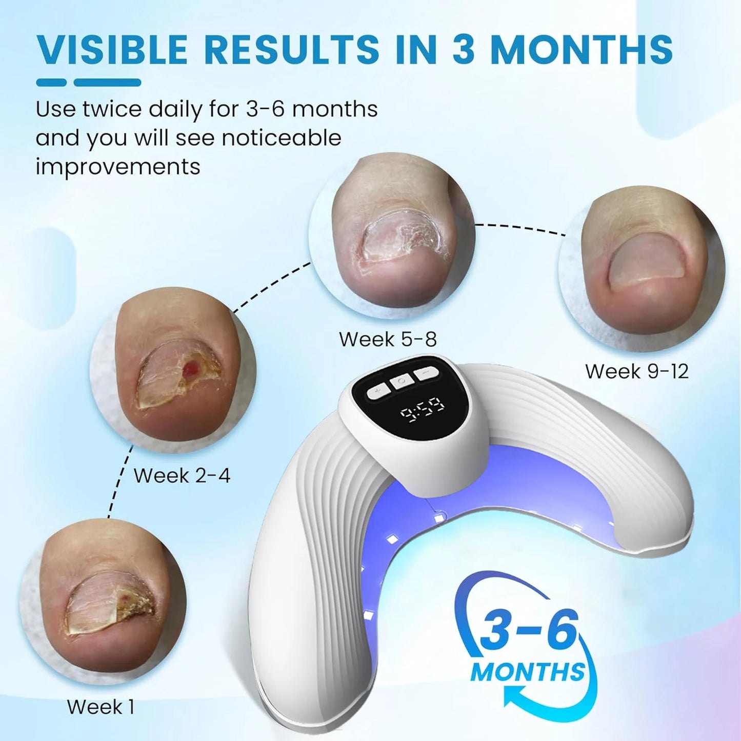 Nail Fungal Laser Treatment Device Repair Anti Infection Paronychia Onychomycosis Ingrown Toenail Foot Care