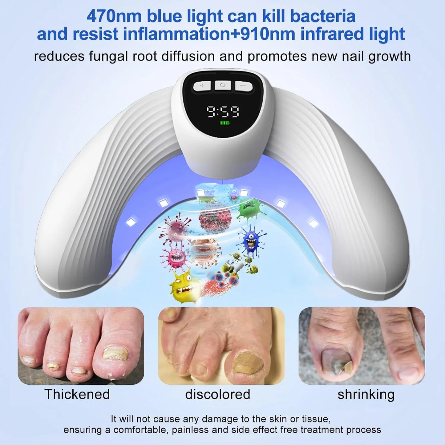 Nail Fungal Laser Treatment Device Repair Anti Infection Paronychia Onychomycosis Ingrown Toenail Foot Care